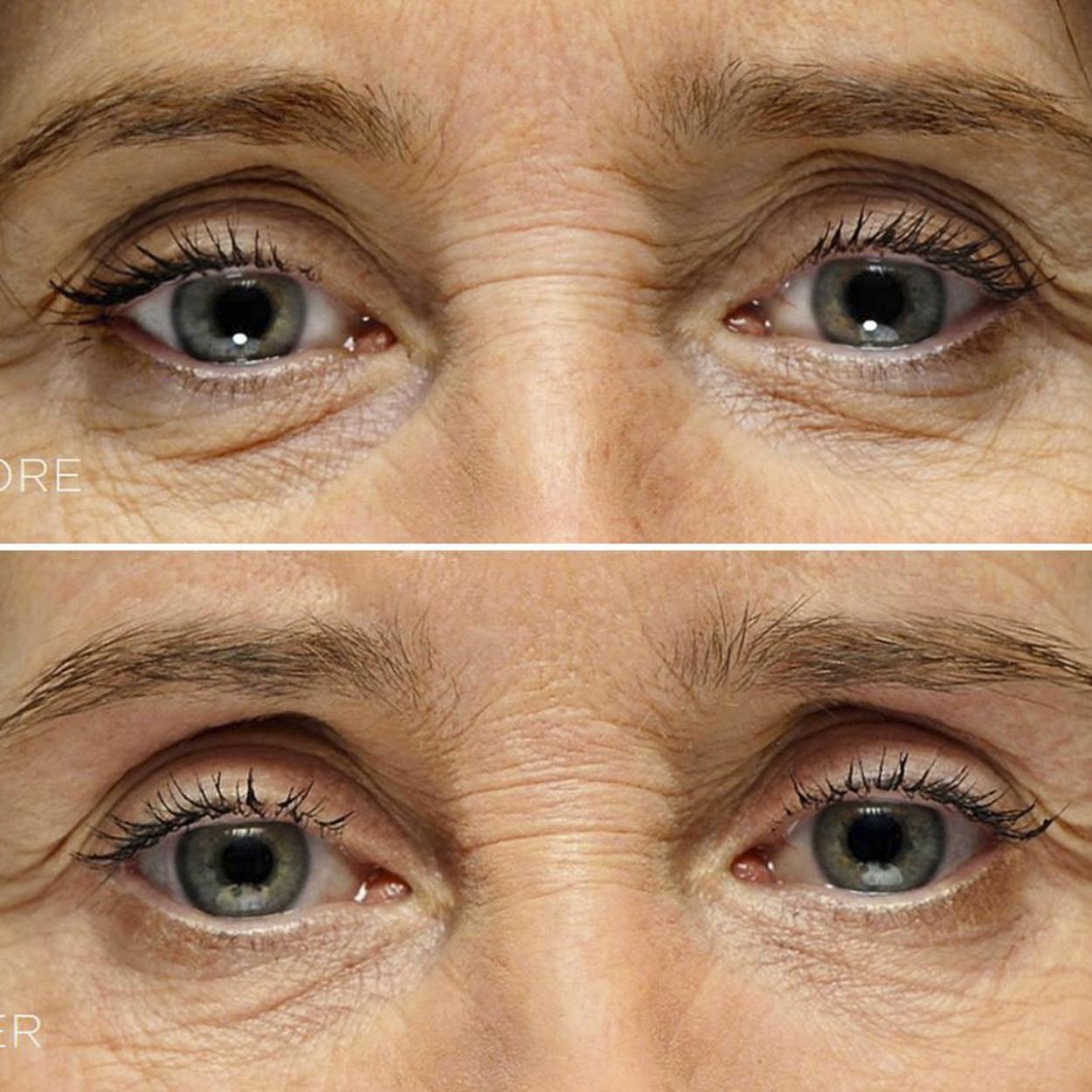 mulher madura preenchimento de olheiras antes e depois