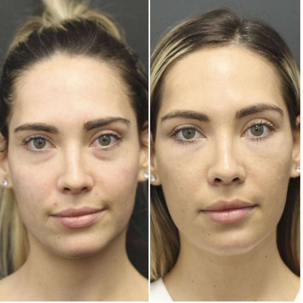 antes e depois preenchimento com ácido na olheira
