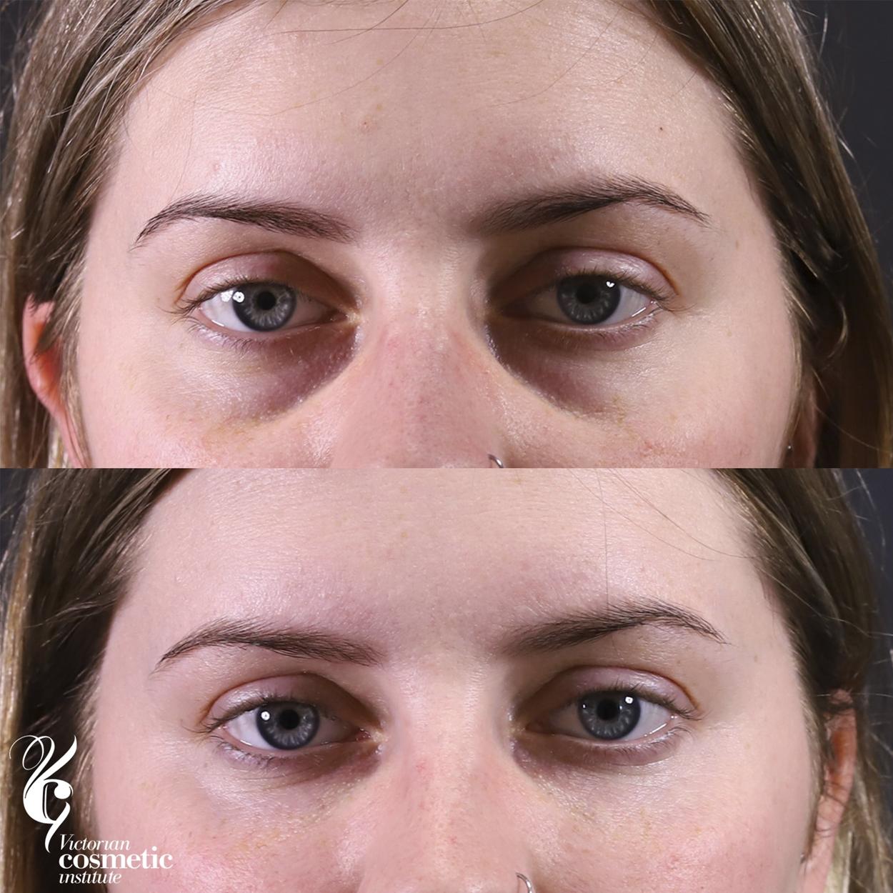 antes e depois de preencher as olheiras com ácido