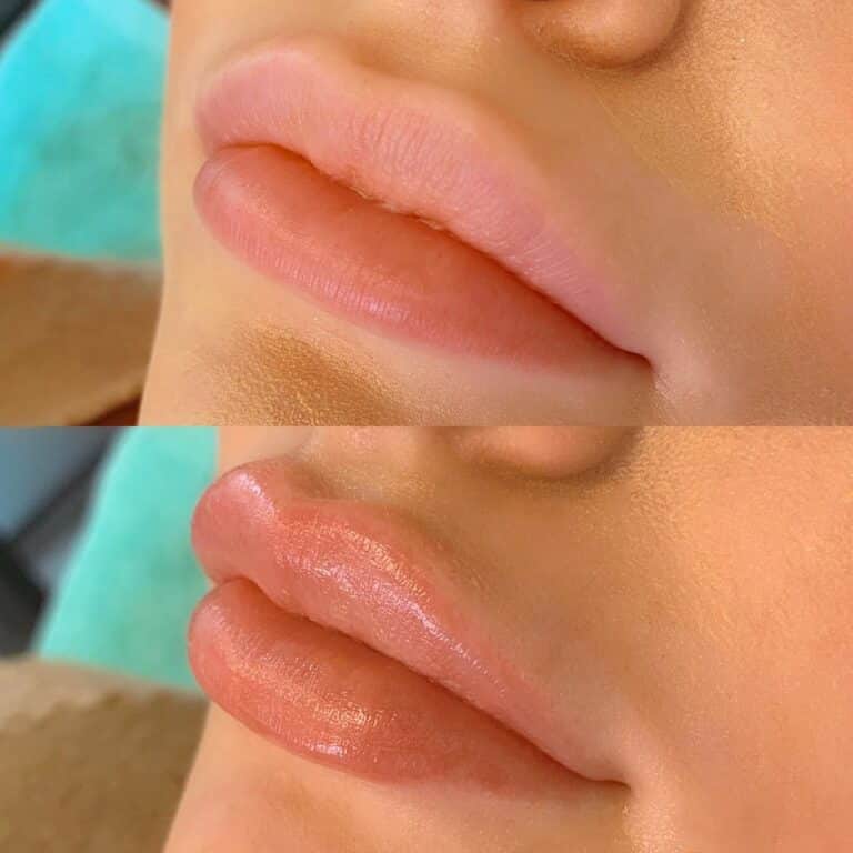 preenchimento labial guia completo sobre como aumentar os lábios