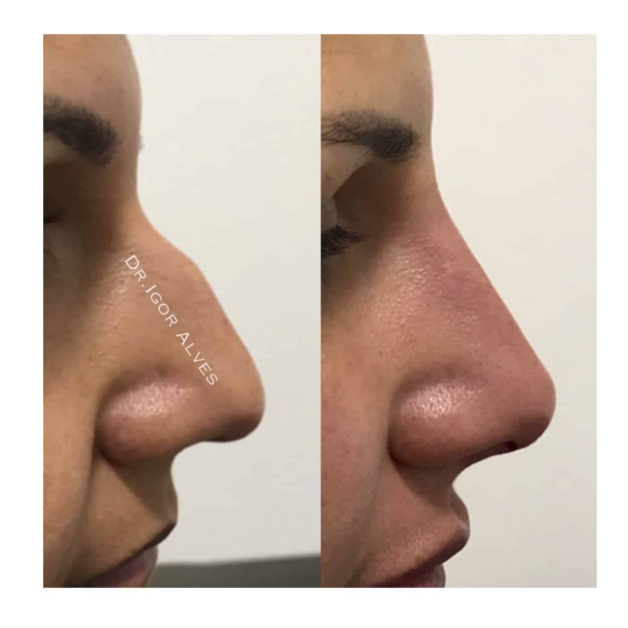 antes e depois preenchimento de nariz