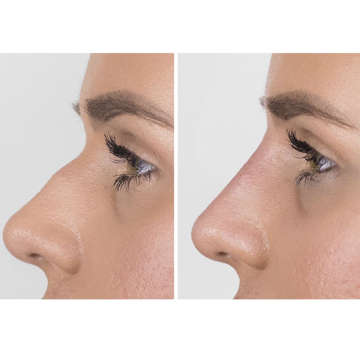 antes e depois rinomodelação preenchimento de nariz