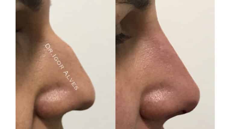 rinomodelação preenchimento de nariz antes e depois_0001_14