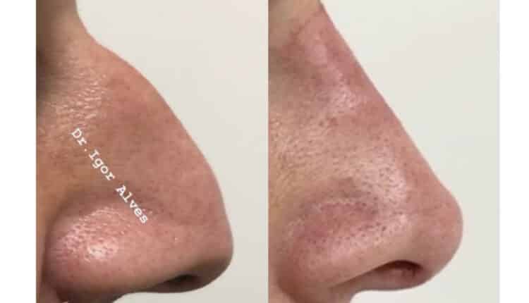 rinomodelação preenchimento de nariz antes e depois_0002_12