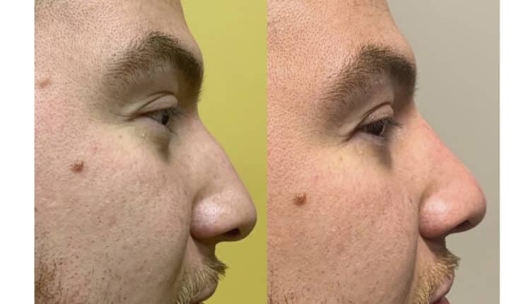 rinomodelação preenchimento de nariz antes e depois_0003_12