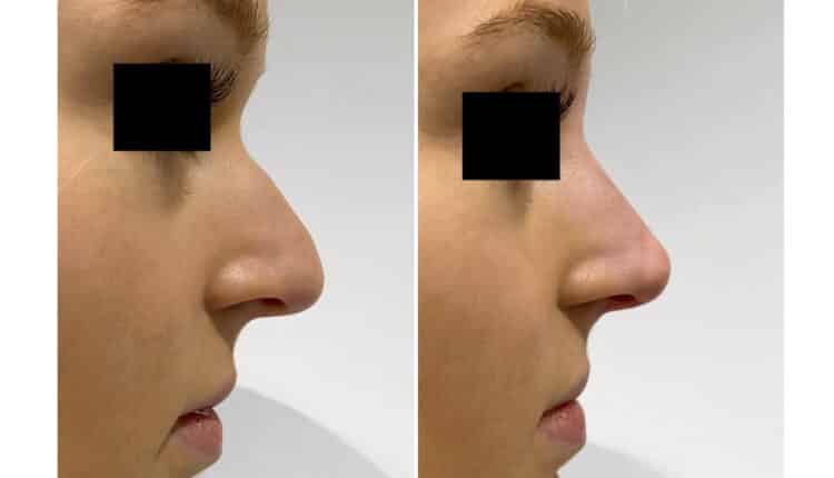 rinomodelação preenchimento de nariz antes e depois_0006_9