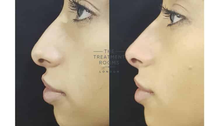 rinomodelação preenchimento de nariz antes e depois_0008_7