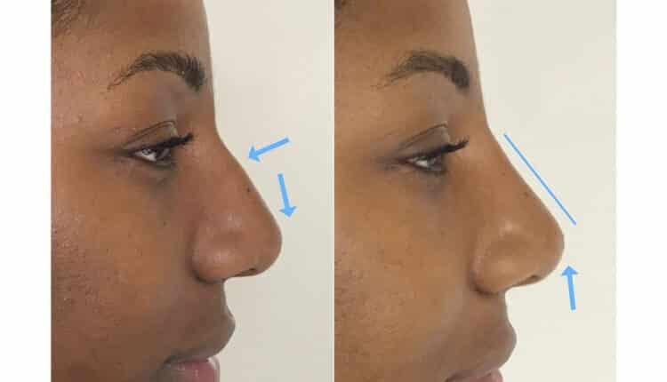 rinomodelação preenchimento de nariz antes e depois_0012_3