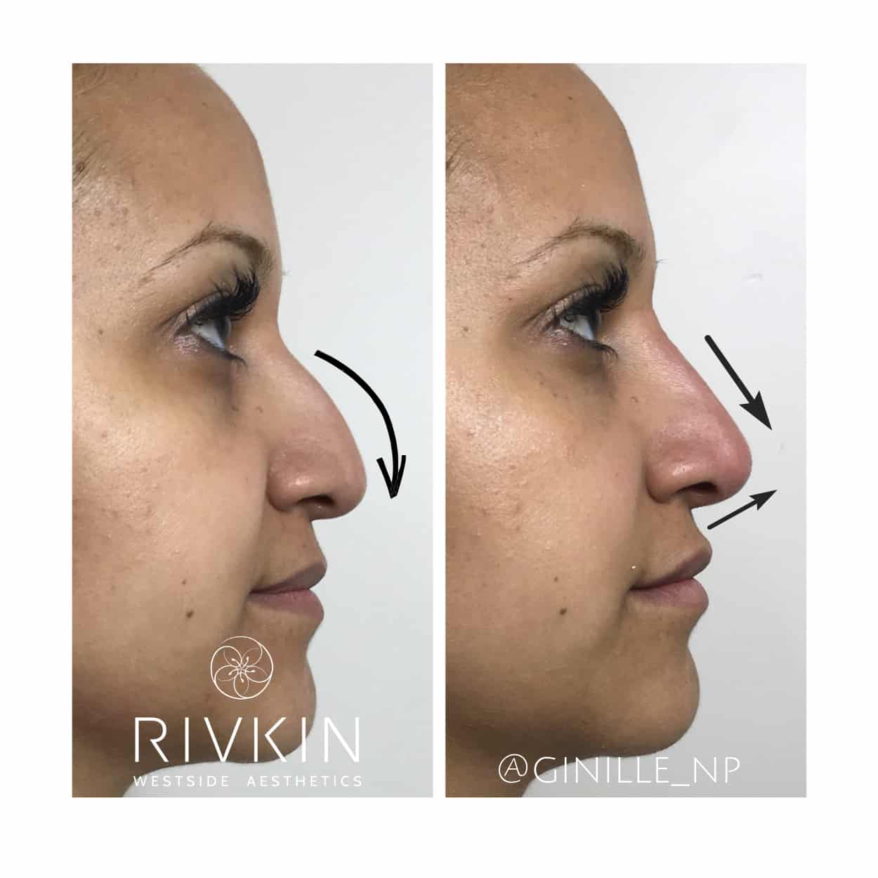 сужение носа ботоксом до и после фото