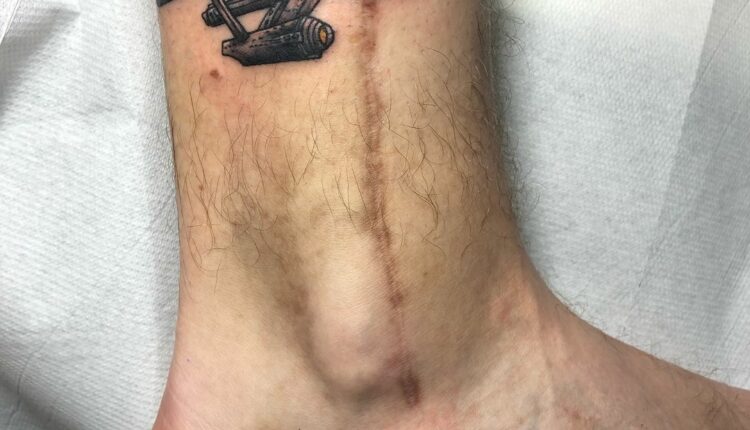 tatuagem para cobrir cicatriz 10
