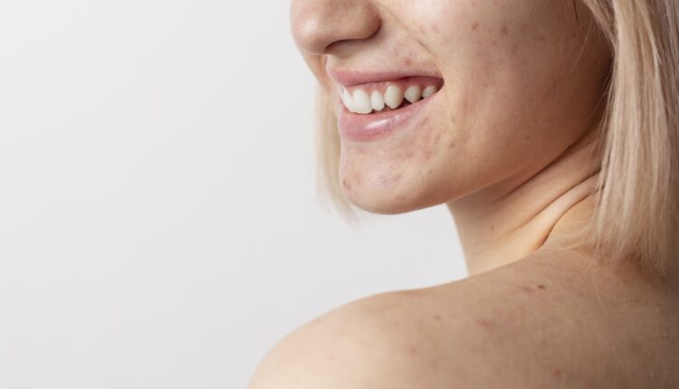 acne hormonal como tratar